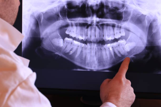 Best Emergency Wisdom Tooth Extraction in Diboll, TX